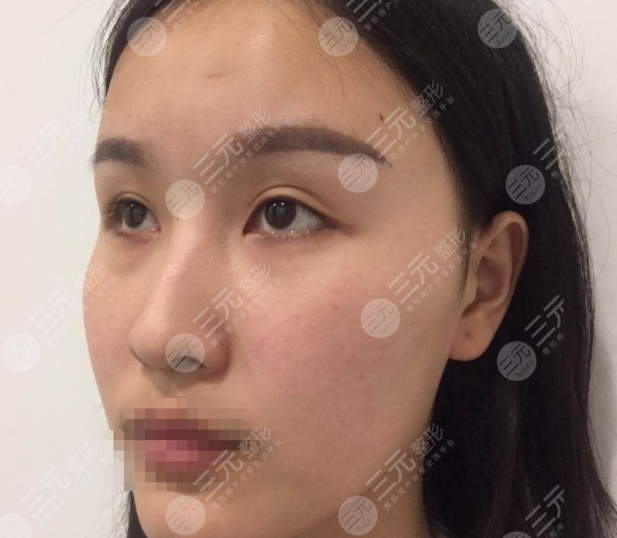 耳软骨隆鼻术前