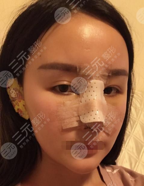 耳软骨隆鼻术后5天