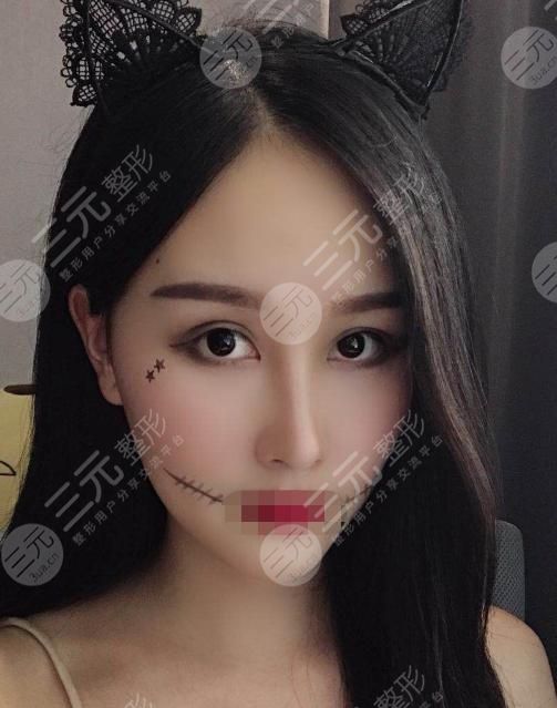 耳软骨隆鼻术后34天