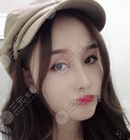 耳软骨隆鼻术后15天