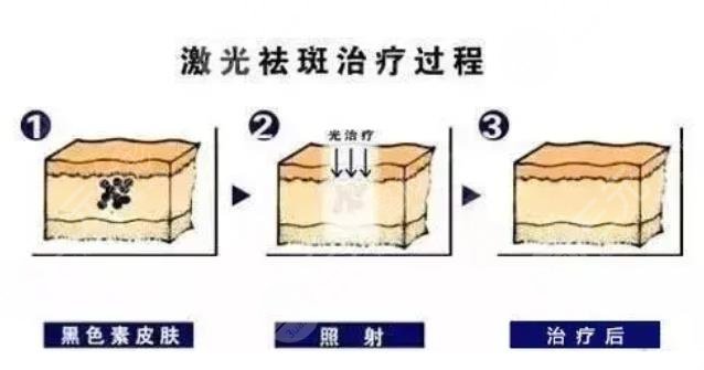 激光祛斑缓解过程