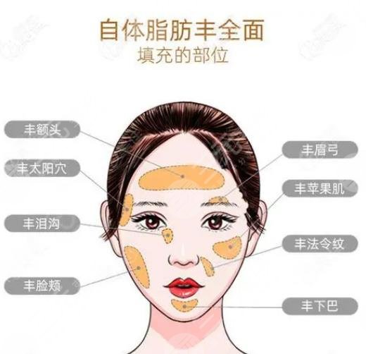 脂肪填充全脸有后遗症较轻(不代表不会出现后遗症)