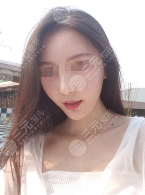 真人体验射频紧肤手术后一个月