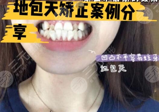 地包天手术整形费用多少钱术前