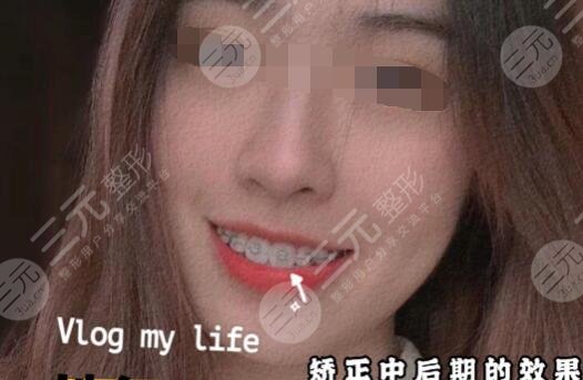 地包天手术整形费用多少钱术后3个月