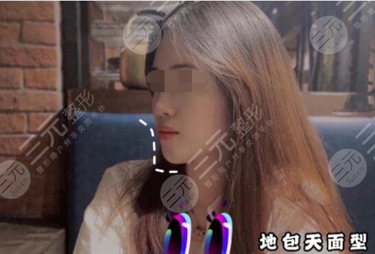 地包天手术整形费用多少钱术后果
