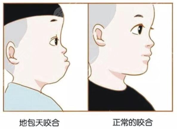 地包天矫正的方法