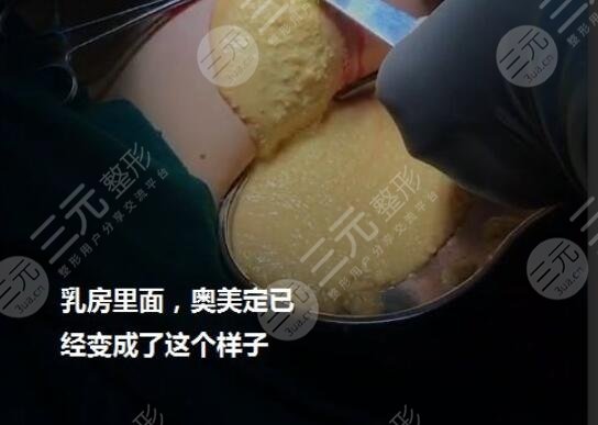 奥美定取出案例