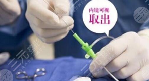 奥美定取出案例