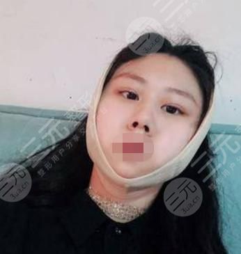 V-LINE瓜子脸手术术后4天