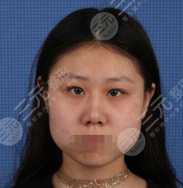 V-LINE瓜子脸手术术前