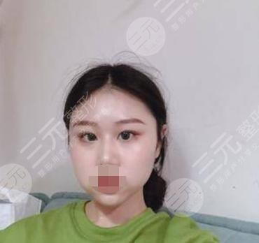 V-LINE瓜子脸手术术后14天