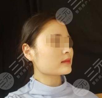 V-LINE瓜子脸手术术前