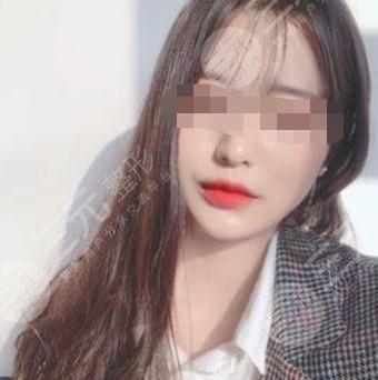 V-LINE瓜子脸手术术后34天