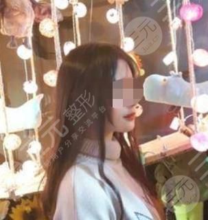 V-LINE瓜子脸手术术后16天