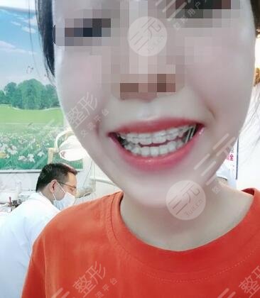深圳诚致美口腔诊所牙齿矫正果图