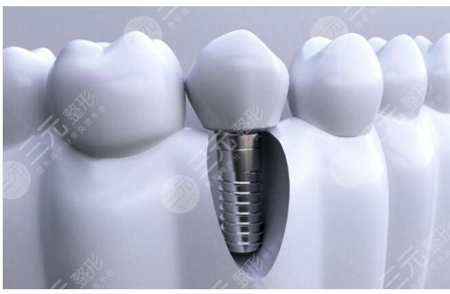 种植牙