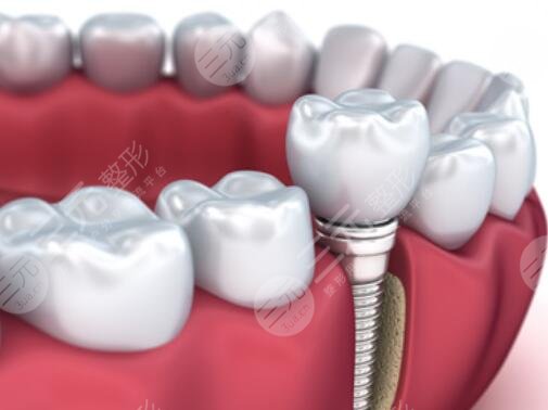 种植牙