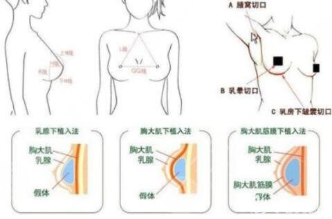 假体隆胸有哪些优势