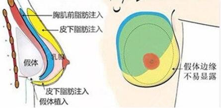 复合隆胸的原理是什么