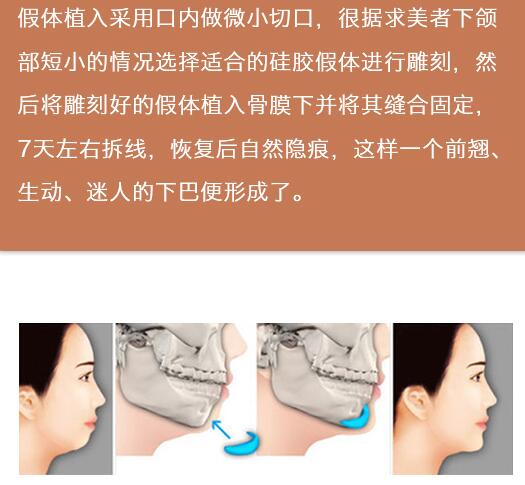 郑广森医生科普颏部整形:垫下巴