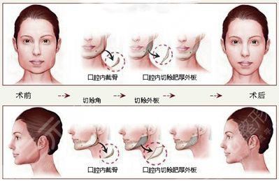 磨骨要恢复多长时间