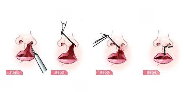 兔唇矫正手术之后需要怎么去护理