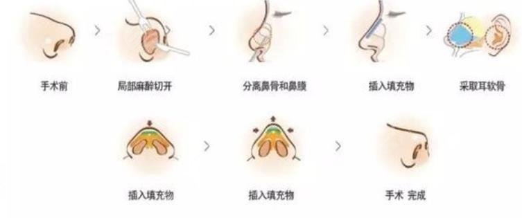 隆鼻原理