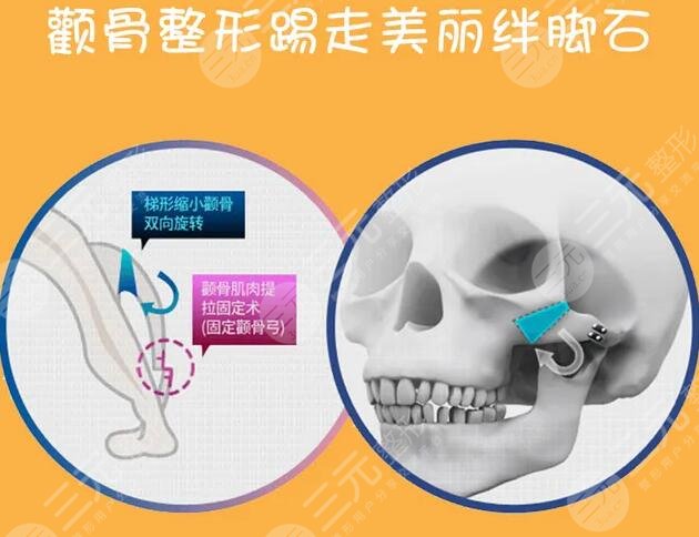 颧骨整形