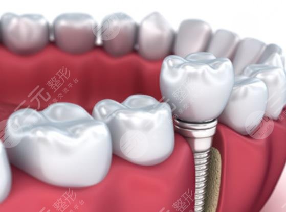 种植牙