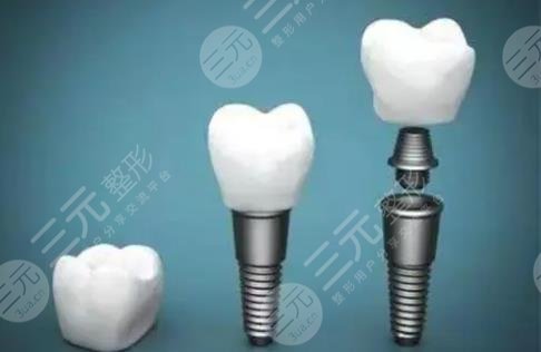 种植牙
