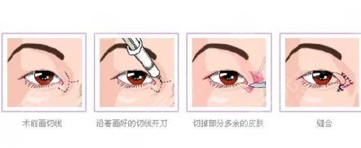 开眼角手术原理