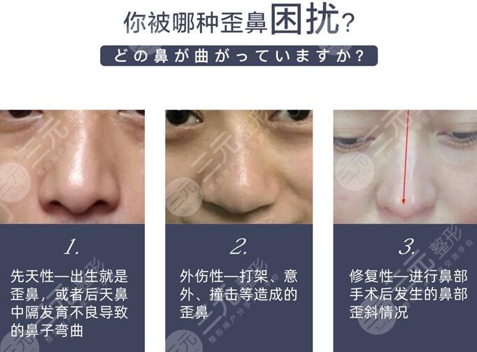 鼻子歪做手术多少钱?歪鼻矫正修复价格参考!果图惊喜种草! 鼻子歪做手术多少钱?歪鼻矫正修复价格参考!果图惊喜种草!