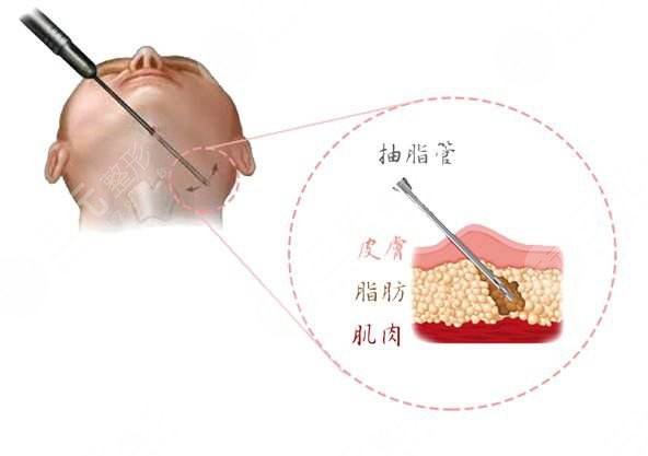 双下巴抽脂术降低风险吗,多久恢复?注意事项+价格攻略分享,附果欣赏! 双下巴抽脂术降低风险吗,多久恢复?注意事项+价格攻略分享,附果欣赏!