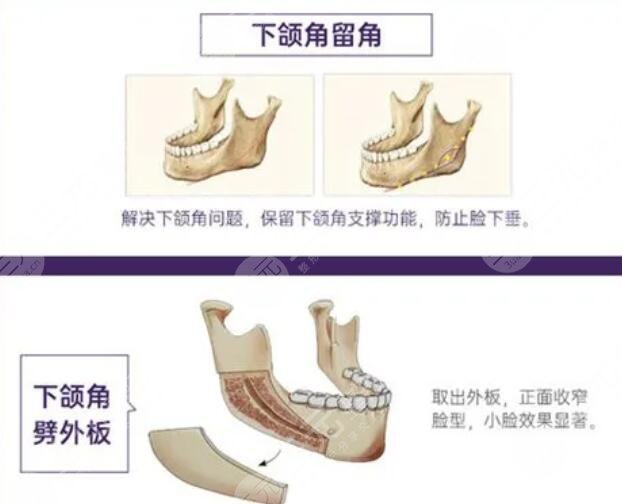 磨骨手术的后遗症