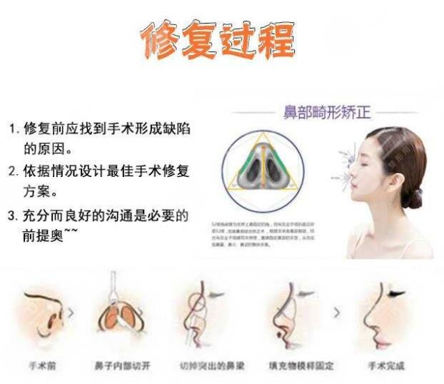哪些情况可以视为隆鼻失败