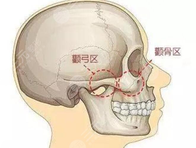 颧骨整形手术的可靠性