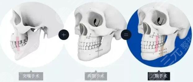 侯振杰正颌手术