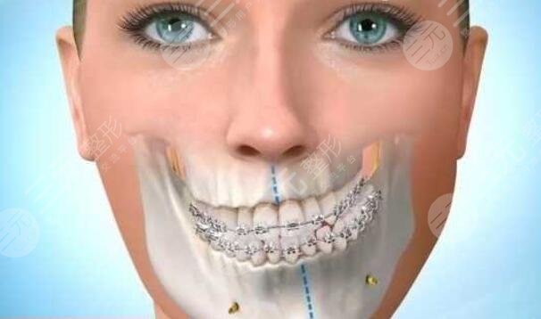 侯振杰正颌手术靠谱吗正颌手术案例面部颜值up人猿变仙女