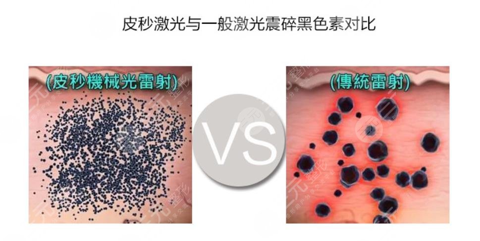 激光pm激光和光子嫩肤的区别