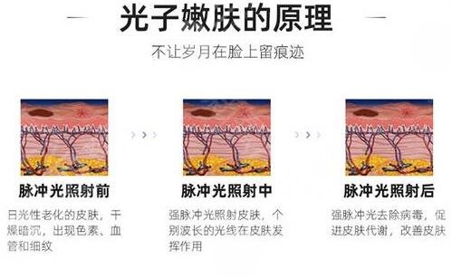 激光pm激光和光子嫩肤的区别