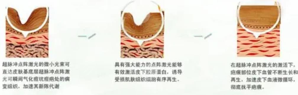 点阵激光美容原理