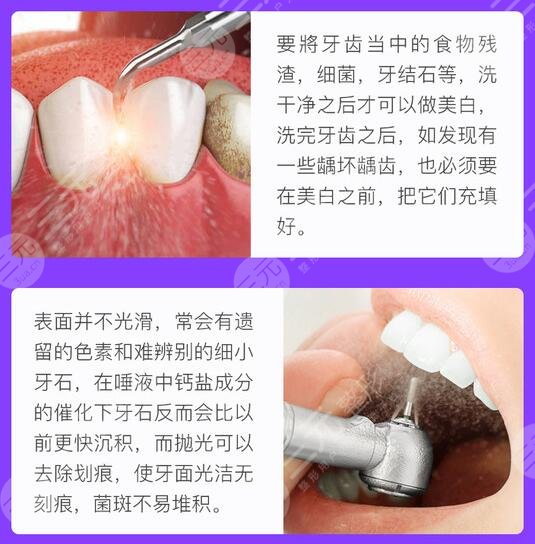 冷光牙齿美白