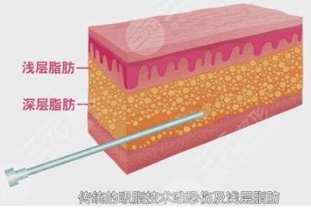 光纤溶脂和吸脂的区别