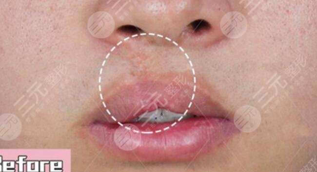真人兔唇矫正前