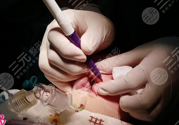 真人兔唇矫正中