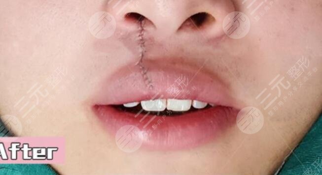 真人兔唇矫正后