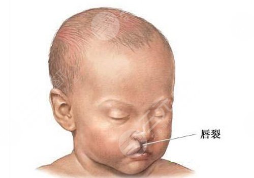 兔唇疤痕修复的时机是什么时候
