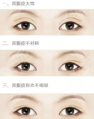 修复双眼皮疼不疼