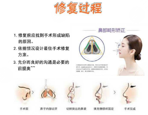 隆鼻修复必须要知道的知识